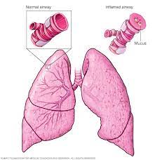 Acute Asthma