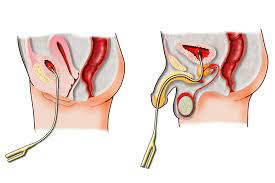 Catheter Associated Urinary Infection (CAUTI)