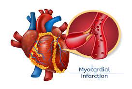 Myocardial Infarction