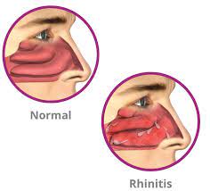 Rhinitis Patient Diagnosis