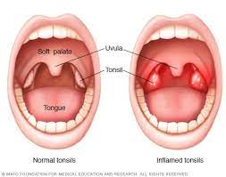 Tonsillopharyngitis Diagnosis